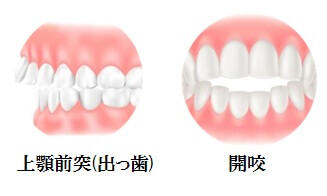 上顎前突・開咬